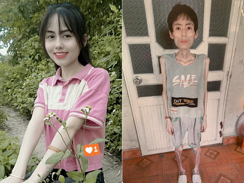 Cô gái Hưng Yên nặng 18kg sau nhiều năm không ăn cơm để giảm cân