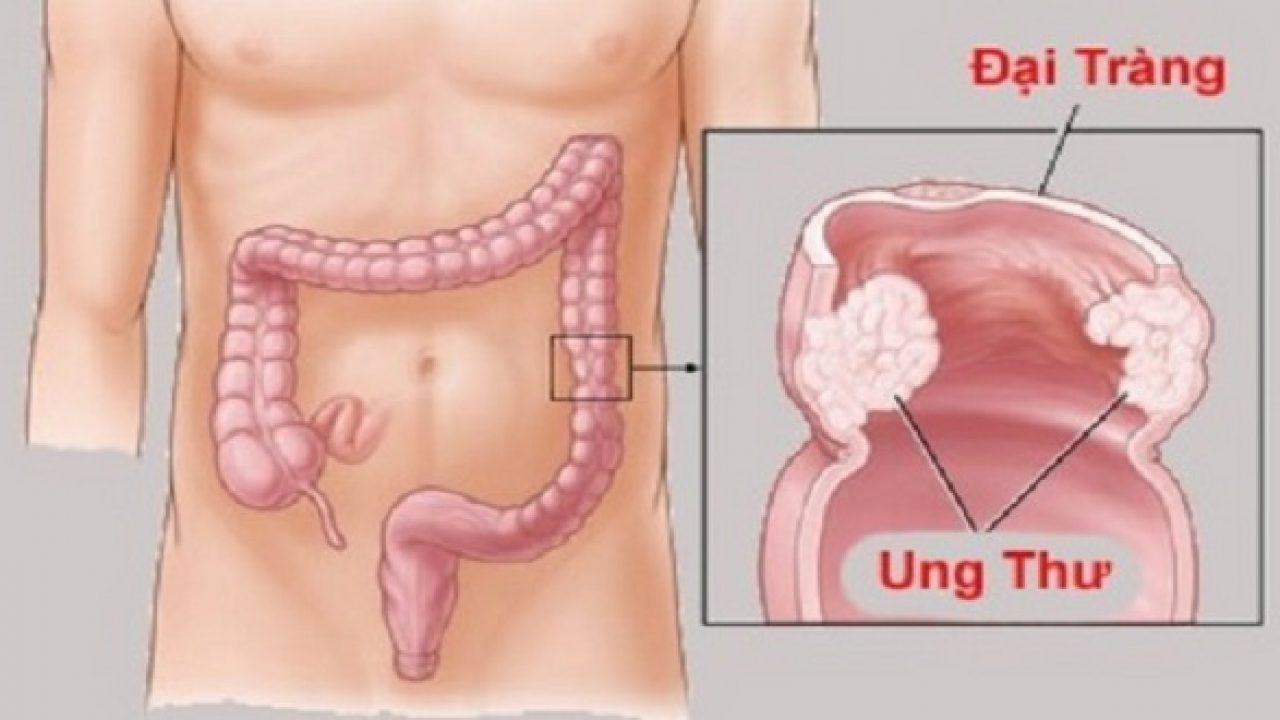 1 loại UT ‘tăng tốc’ đáng báo động ở Việt Nam: Bác sĩ Bạch Mai cảnh báo gấp