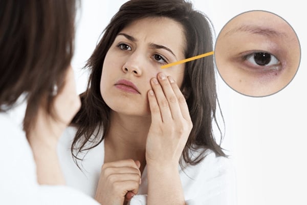 Thâm Quầng Mắt không do Mất Ngủ: Có thể là dấu hiệu 3 bệnh nguy hiểm