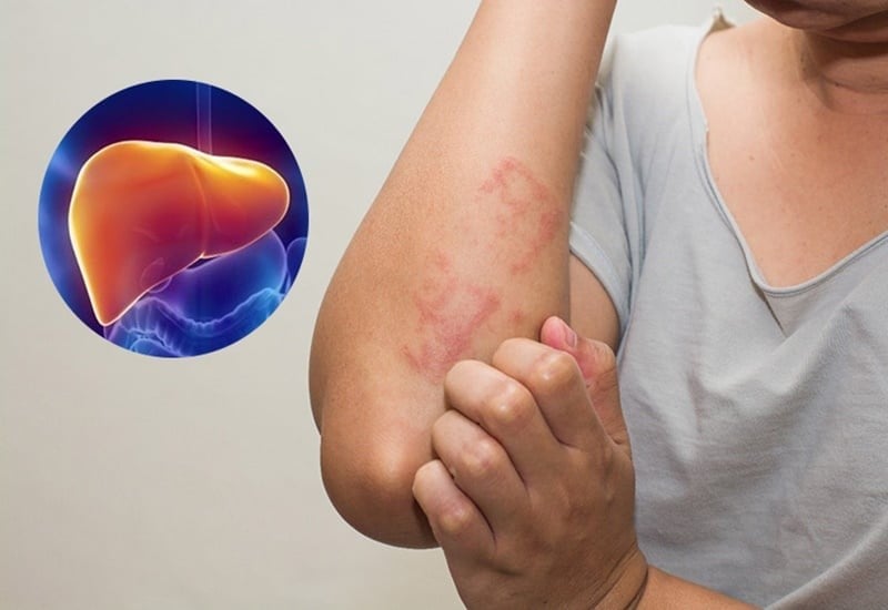 7 dấu hiệu bệnh gan đã đi vào giai đoạn nặng