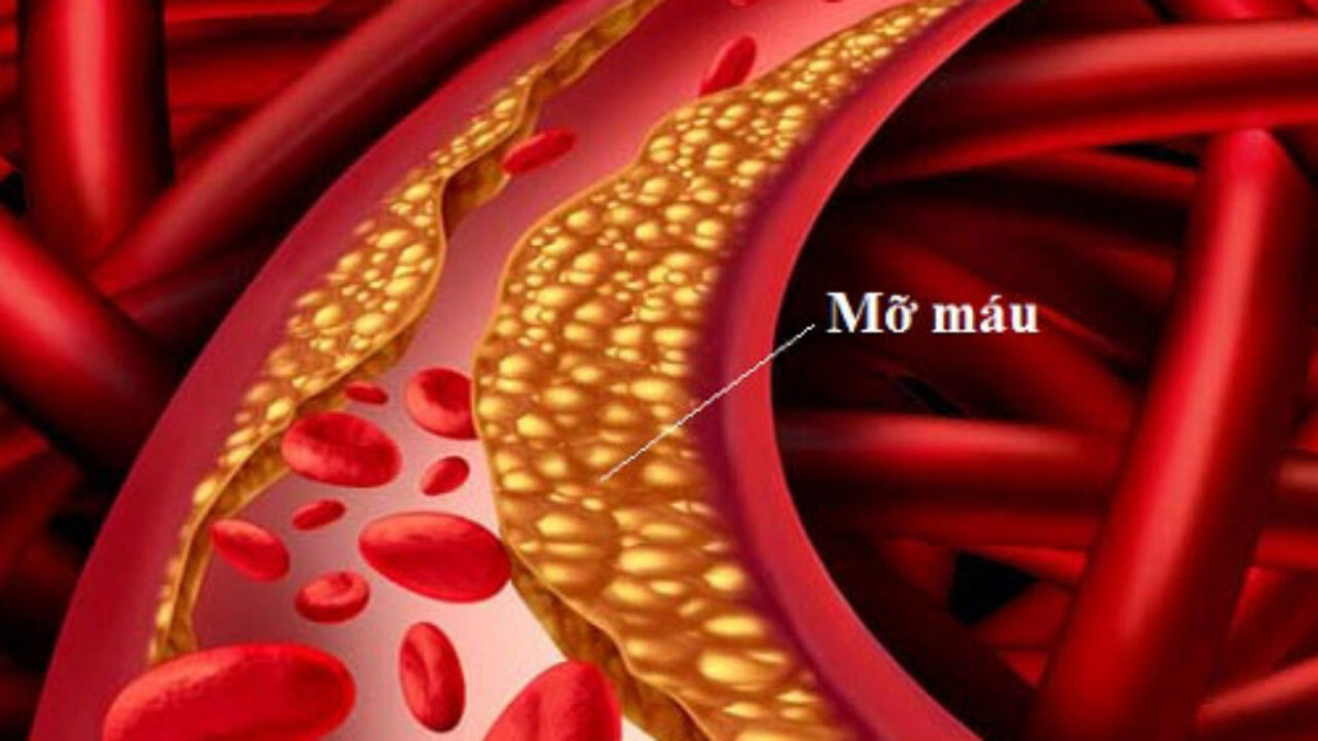 Vì sao người gầy mà m: ỡ m: áu cao? Nên ăn gì và kiêng ăn gì để kiểm soát bệnh hiệu quả?