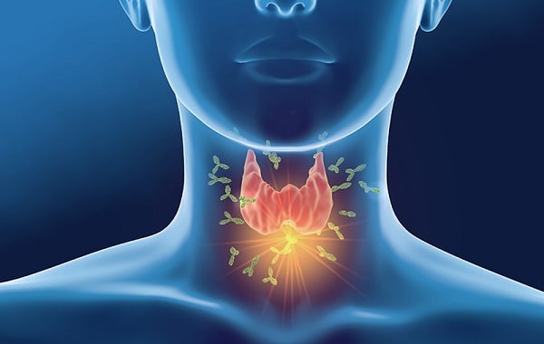 Lý do khiến bạn dễ mắc u tuyến giáp