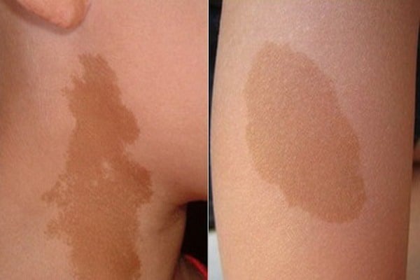 Trẻ sinh ra có vết bớt ở 6 vị trí dự báo số mệnh thiên kim, tương lai cực kì tài giỏi và giàu có