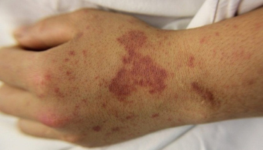 TP.HCM cảnh báo bệnh cực nguy hiểm, có thể gây tuvong chỉ sau vài giờ