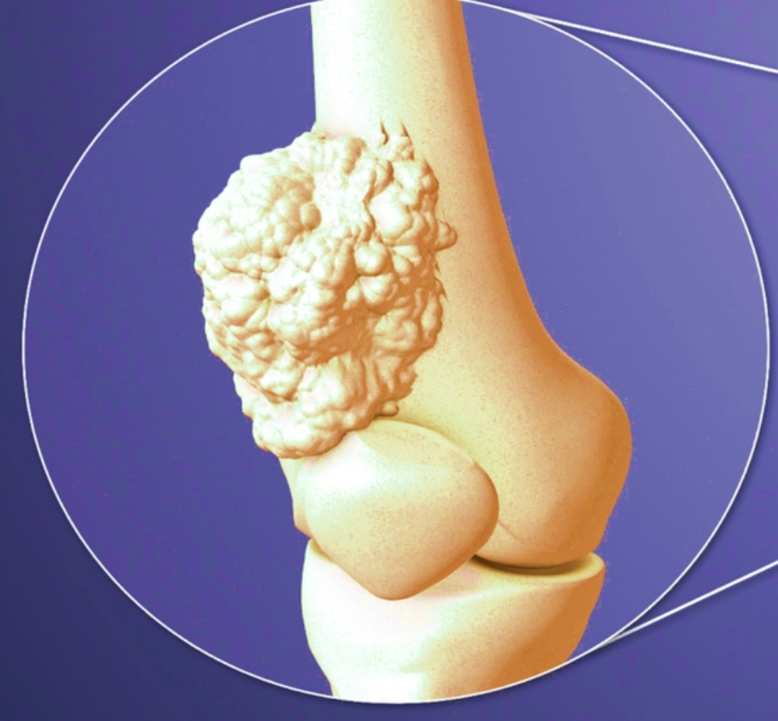 6 dấu hiệu UT xương mà nhiều người hay nhầm với thiếu canxi